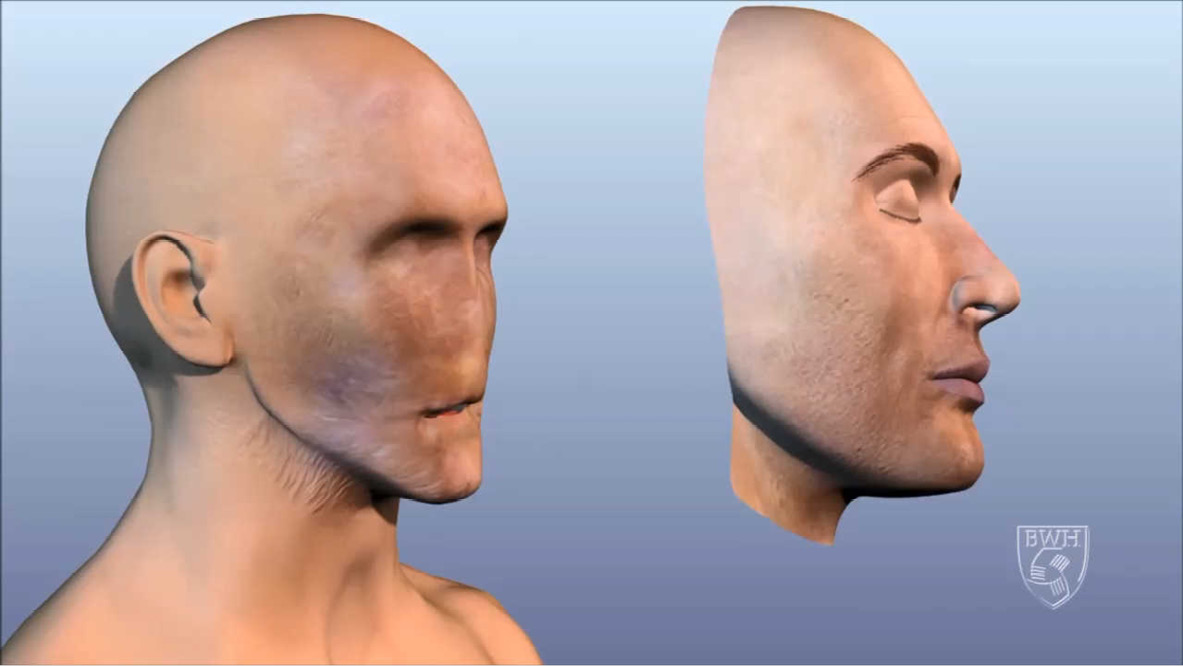 Facial allograft transplantation Hustlers barely legal 108